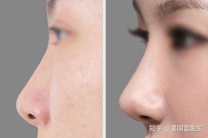 硅胶假体隆鼻价格，全面解析与深度探讨