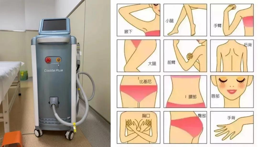 光子脱毛美容，现代脱毛技术的革新之选