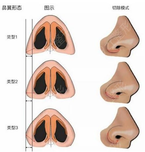 鼻翼缩小手术价格详解，因素、费用及注意事项