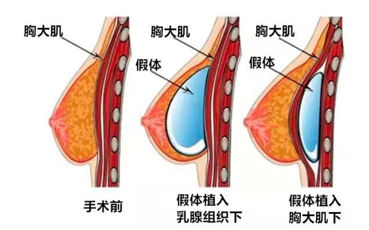 假体隆胸取出，过程、原因及后续关注